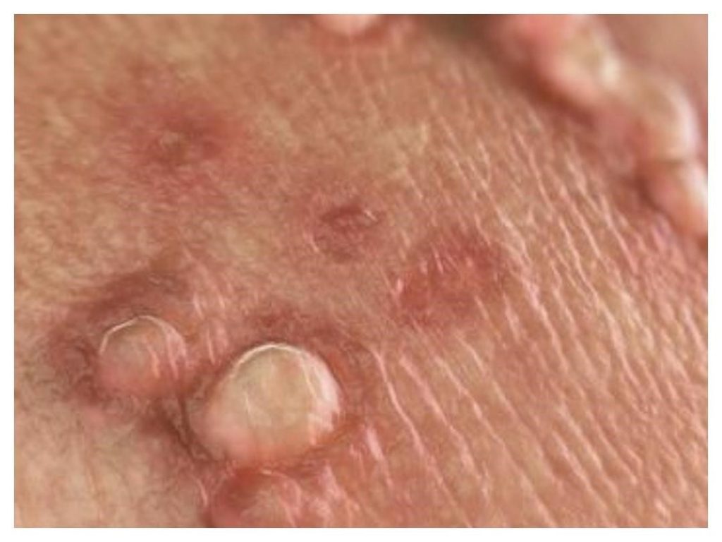 درمان HPV