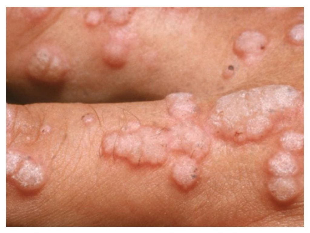 درمان HPV