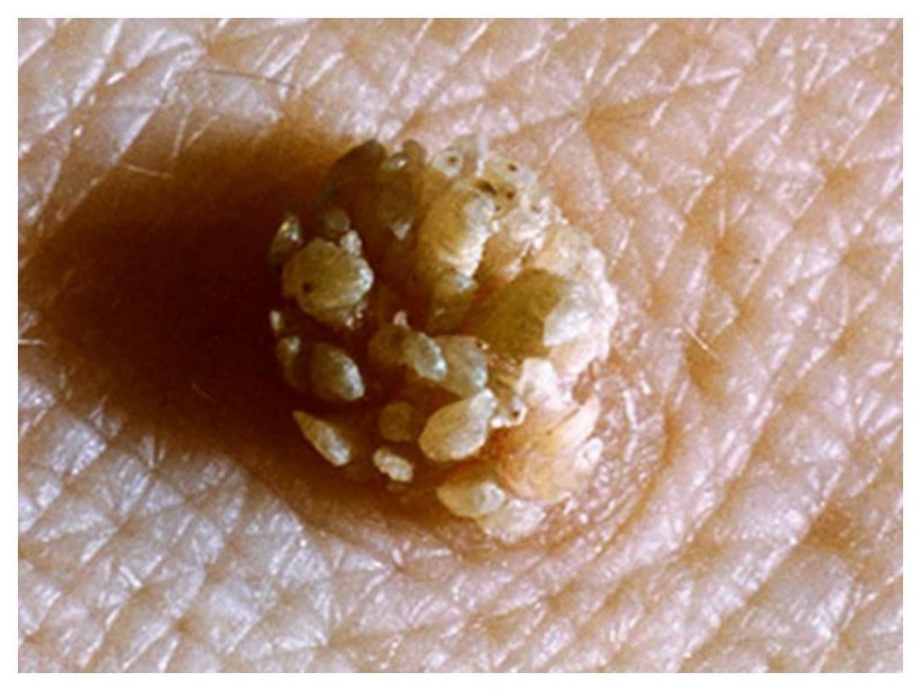 درمان HPV