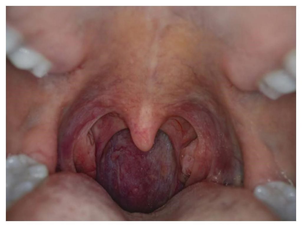 عفونت HPV