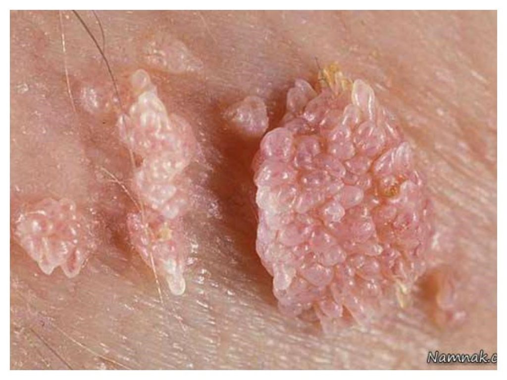عفونت HPV
