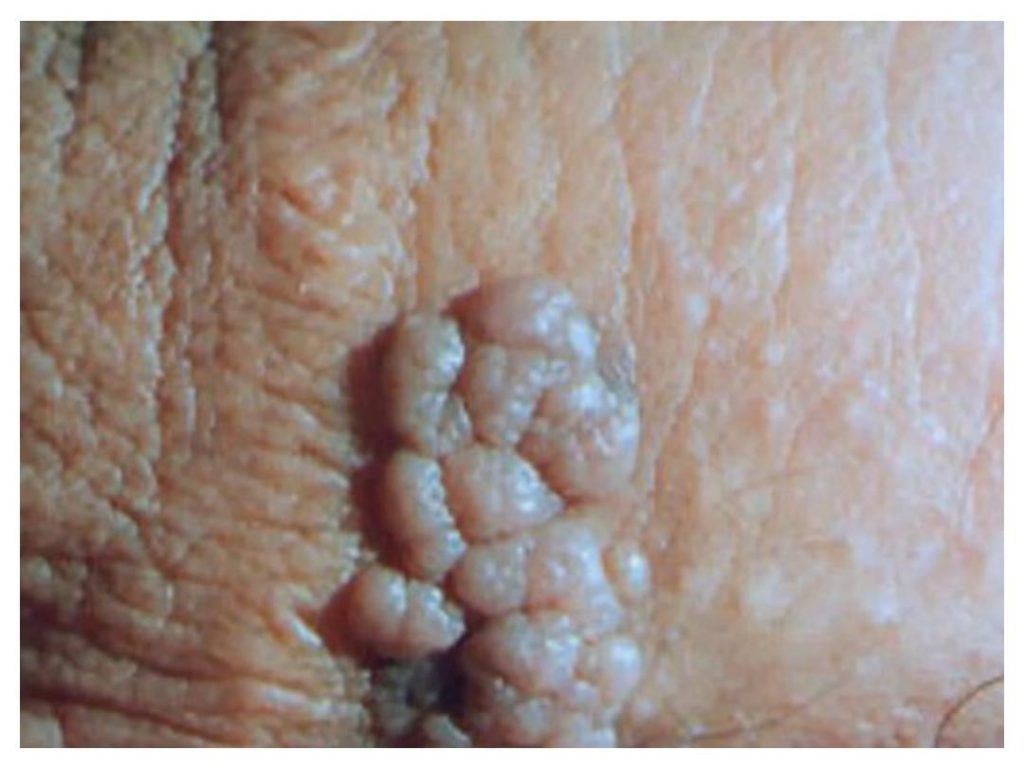 عفونت HPV