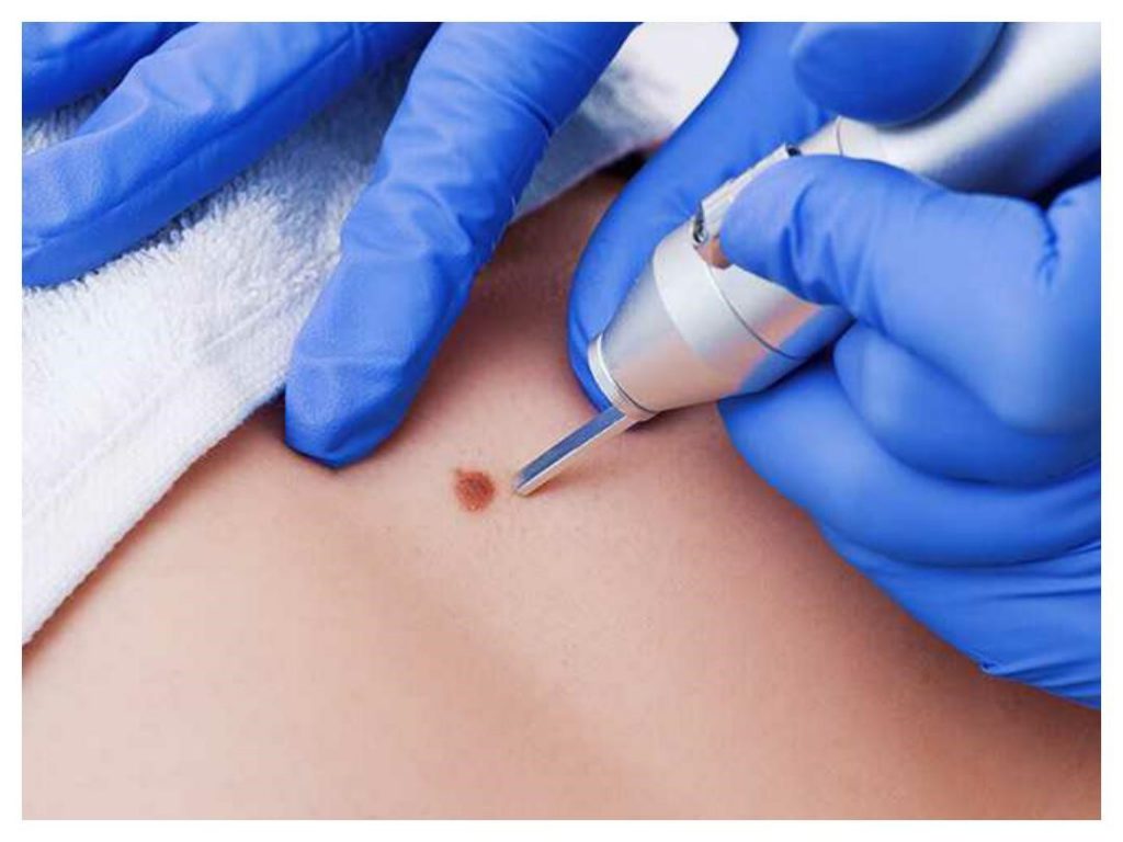 عفونت HPV