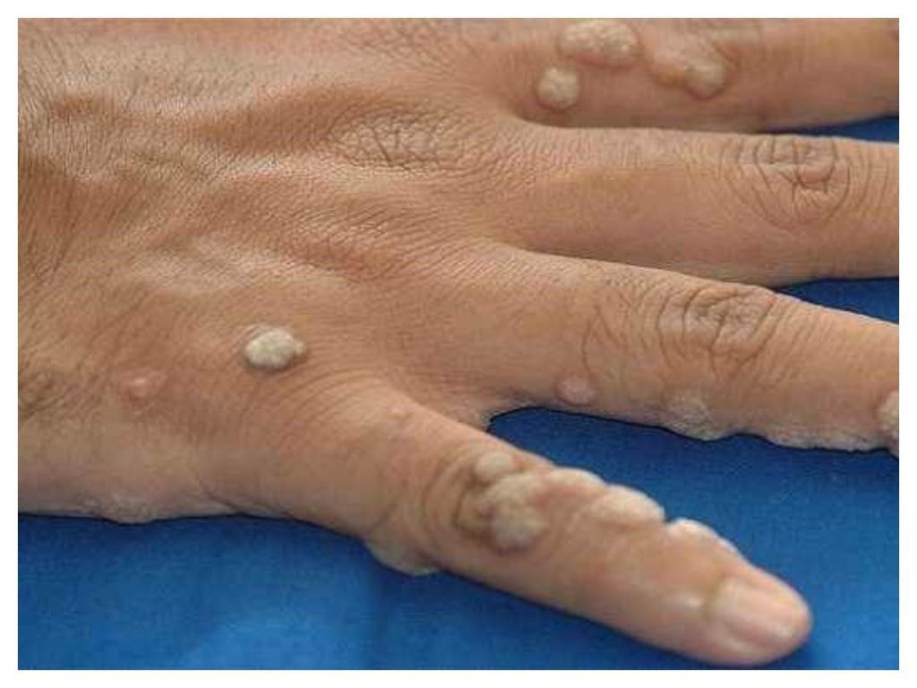 ویروس HPV