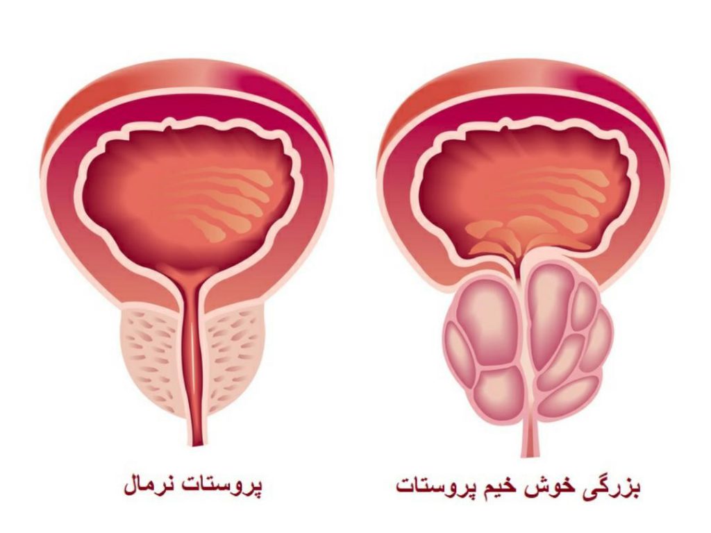 عفونت ادراری در آقایان
