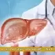آزمایش کبد چرب چیست و کبد چرب چه علائمی دارد