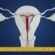 آی یو دی چیست و همچنین مزایای ای یو دی و معایبی ان در چیست؟ IUD