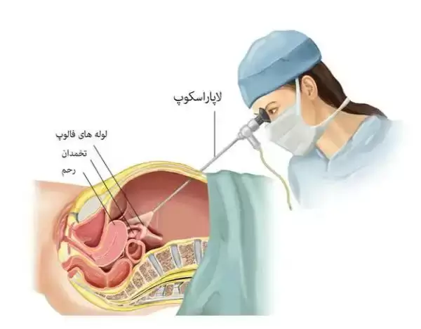 تلقيح نطفه داخل لوله رحم درمان ناباروری