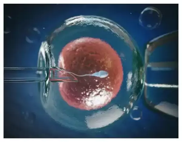 لقاح مصنوعی (IVF) درمان ناباروری