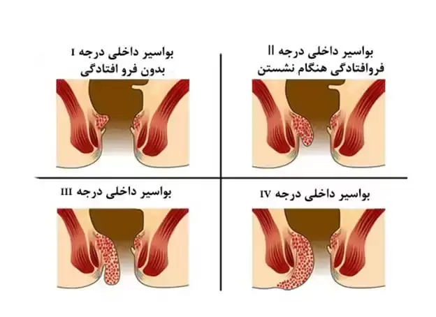 بواسیر