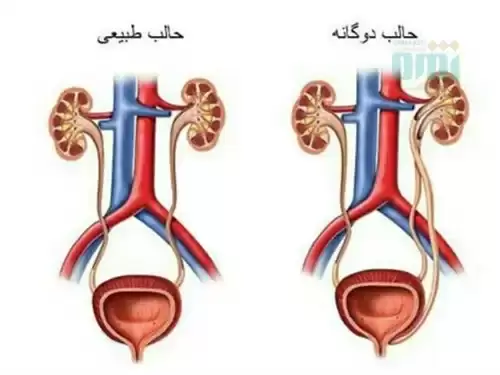 بیماری های کلیوی