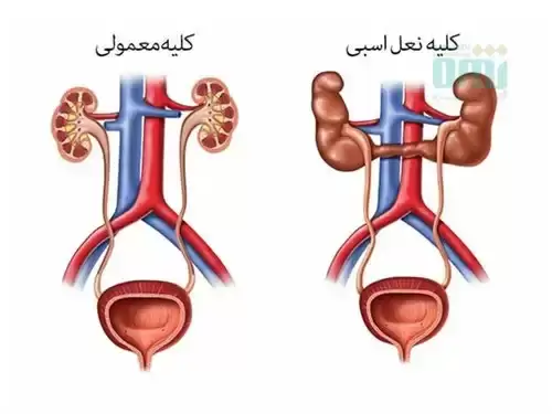 نارسایی کلیه