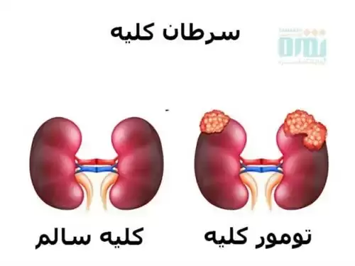 بیماری های کلیه