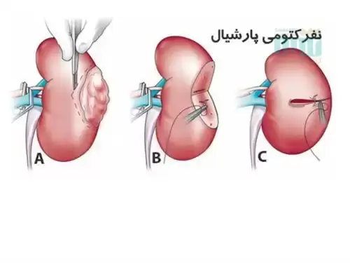 بیماری های کلیه