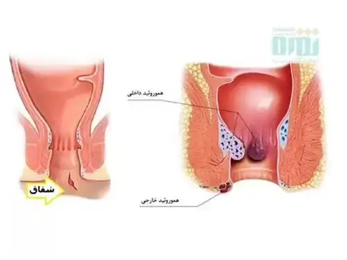 درمان بواسیر