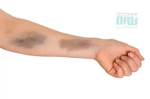 سرطان پلاکت خون